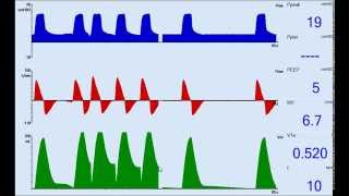 Ventilator Asynchrony Auto Trigger [upl. by Ecart]