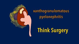 Xanthogranulomatous Pyelonephritis sketchy format [upl. by Notxarb]