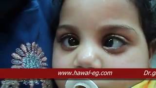 Nystagmus Blockage Syndrome  الرأرأة  العيون الراقصة [upl. by Lorelle515]