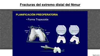 FRACTURA DE FEMUR DISTAL [upl. by Adnahsal]