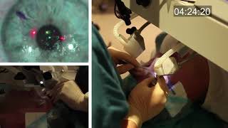 Realtime uncut unedited LASIK procedure live with real sound [upl. by Susanna]