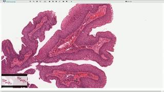 Squamous Papilloma  Larynx  Histopathology [upl. by Gainer]