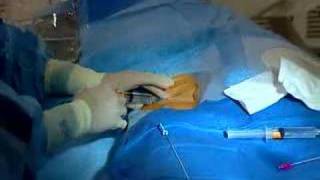 Live Webcast Cardiac Catheterization Angioplasty amp Stent [upl. by Eninnej]