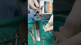 Cemented total hip replacement🏥 femoralstem drgauravkhera ytshorts youtubeshorts [upl. by Grantham]