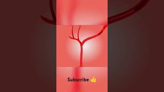 cerebral ischemic stroke Brain ischemic stroke treatment3d Animation Carotid Endarterectomy [upl. by Camile286]