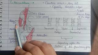 Fracture Shaft Of Femur introductiondiagnosisTreatmentComplications [upl. by Els]