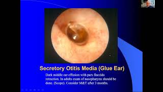 Otoscopic Ear Findings with Dr Charles Weingarten  November 20 2023 [upl. by Annagroeg572]