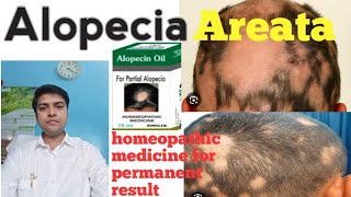 Homeopathic medicine for Alopecia areata  explain everything l permanent result l Drrakeshbharti [upl. by Enorel]