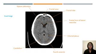 CT Head Sectional Anatomy  ARRT Registry and CQR Review [upl. by Stanfill799]