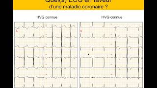 Infarctus ou et HVG  Quiz Dr Taboulet [upl. by Assel]