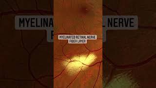 Myelinated Retinal Nerve Fiber Layer retina oftalmo ophthalmology oftalmologia oftalmología o [upl. by Sukramal]