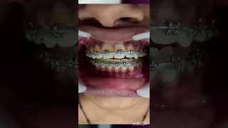 Two Expanders  Upper amp Lower RPE  Tooth Time Family Dentistry New Braunfels Texas Braces [upl. by Serilda]