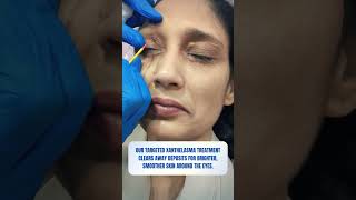 Xanthelasma Treatment  Skin Clinic  Kolkata  Skin Treatment  youtubereels youtubeshorts [upl. by Gnouhk]