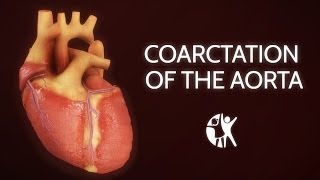 Coarctation of the Aorta [upl. by Anoy447]