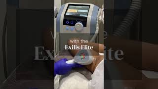 Sagging Arms Begone with Exilis Elite [upl. by Schreib]