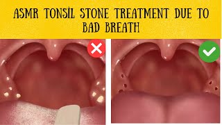 Asmr tonsil stones treatment transformation [upl. by Hughes]