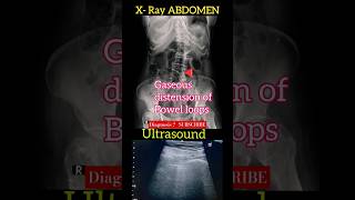 Gaseous distension of bowel loops  X  Ray Abdomen amp USS Abdomen  Diagnosis  Radiology [upl. by Ronel]