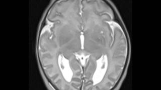 PARTIAL Agenesis of Corpus Callosum [upl. by Errehs]