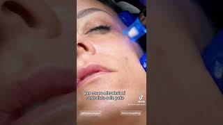 Microneedling microneedling trattamentiviso [upl. by Gavrilla]