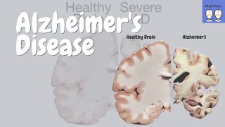 Alzheimers disease Pathophysiology Amyloid plaques and Tau tangles Risk Factors Treatment [upl. by Noillimaxam]