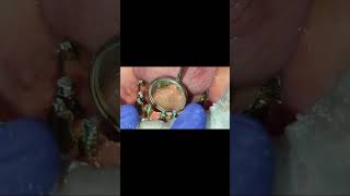 Proper Alveoloplasty  No gum shrinkage even after 2 years  Mandible full implants [upl. by Bowyer]