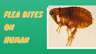 Flea Bites vs Bed Bug Bites  How to Tell Which One You Have [upl. by Templer94]