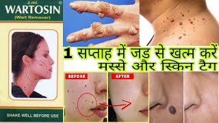 Wartosin।। Wartosin Wart Remover In Hindi।। Wartosin Review।। लटकते मस्सों को जड़ से हटाए [upl. by Eivla377]