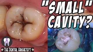 Restoring A Tooth Back To Its Original Shape C17 [upl. by Onaicram]