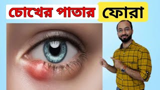 চোখে অঞ্জনি হলে করনীয়  Chalazion Treatment চোখের পাতা ফুলে গেলে করনীয় ক্যলজিয়ান আঞ্জনি anjoni [upl. by Babara749]