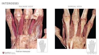 Anatomy of the Upper Limb Interossei and Lumbricals [upl. by Donavon]