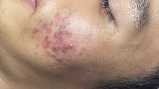 ACNE TREATMENT VU QUYNH MI Acne On Teens Cheek 2024 [upl. by Mauldon]