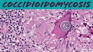 Coccidioidomycosis Coccidioides 5Minute Pathology Pearls [upl. by Anegal]