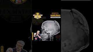 TRAUMATISMO CRANIANO👨🏻‍🏫💀⚡☢️🩻🥼🚀 professorionizante professoralexmateus radiologia anatomia [upl. by Edita]