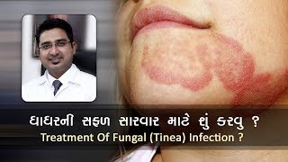 Ring wormFungal Infection Tinea Dhadharदाद  treatment tips in Gujarati by Kayakalp clinic [upl. by Hsuk]