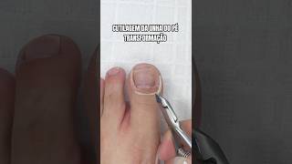 Transformação incrível da unha do pé 😍 pedicure manicure unhasdospés unhas pes [upl. by Benjy]