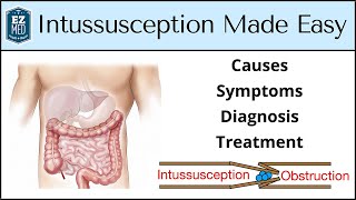 Intussusception Causes Symptoms Diagnosis Treatment Nursing USMLE [upl. by Christine]