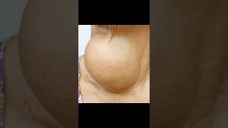 Goiter Huge Thyroid Growth in Someone’s Neck [upl. by Xet]