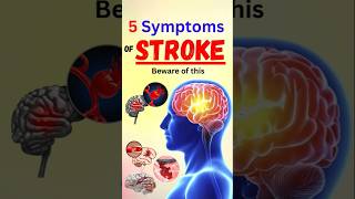 5 Symptoms of Stroke Beware of this [upl. by Krista246]