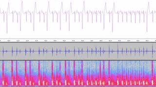 Hearbeat with 14 PVCs in half a minute [upl. by Wershba]