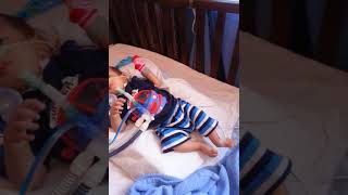 Baby with tracheostomy on ventilator with ICU at home [upl. by Marie-Jeanne]