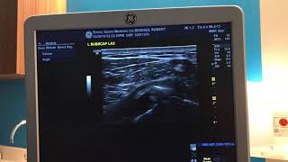 Ultrasound Guided Barbotage Procedure for Calcific Tendonitis in Shoulder [upl. by Nirroc]