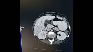 Liver abscess  Periportal haloPeriportal collar sign [upl. by Atimad]