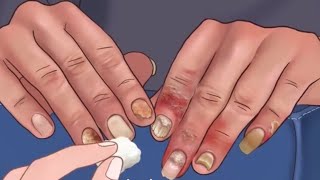 ASMR oral antifungal drugsnail fungus treatmentdiagnosis treatment in nailmedicure for nail💅 [upl. by Sreip]