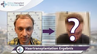 Haarimplantation Ergebnisse Vorher Nachher [upl. by Meeharb991]