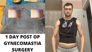 POST OP GYNECOMASTIA SURGERY 2 [upl. by Cruce260]