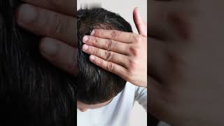 Minoxidil  Uses  Side Effects  Precautions shorts viralvideoshorts [upl. by Nylteak]