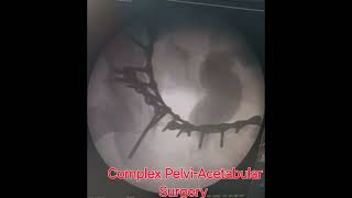 Complex PelviAcetabular Surgery  Dr Nikhil Verma complextrauma complexhipfracture acetabulum [upl. by Omora]