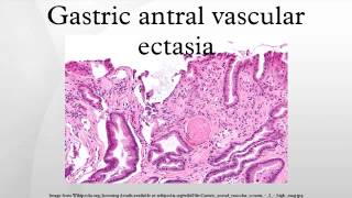 Gastric antral vascular ectasia [upl. by Etam]