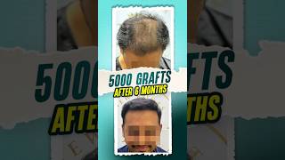 5000 Grafts Hair Transplant  Raipur hairtransplant raipur shorts ytshorts [upl. by Neesay]