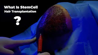 What is stem cell hair transplantation [upl. by Aihgn222]